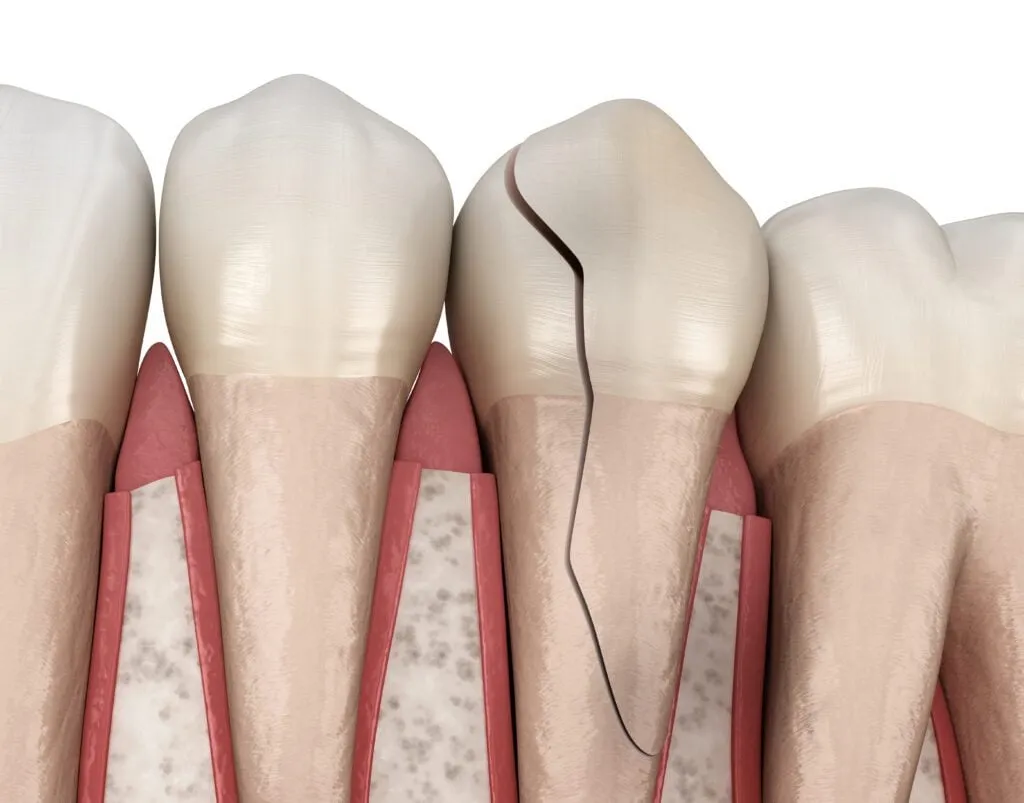 6 Immediate Steps: Emergency Cracked Tooth Repair in Falls Church