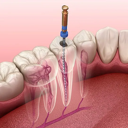 The Crazy History of the Endodontic Field