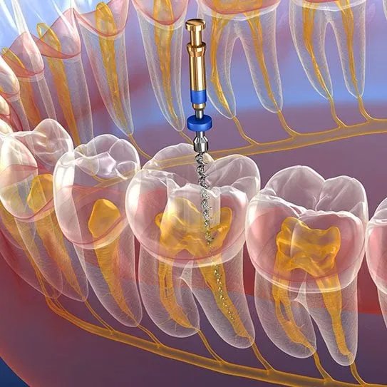 Ultimate Guide to Root Canal VA: Everything You Need to Know