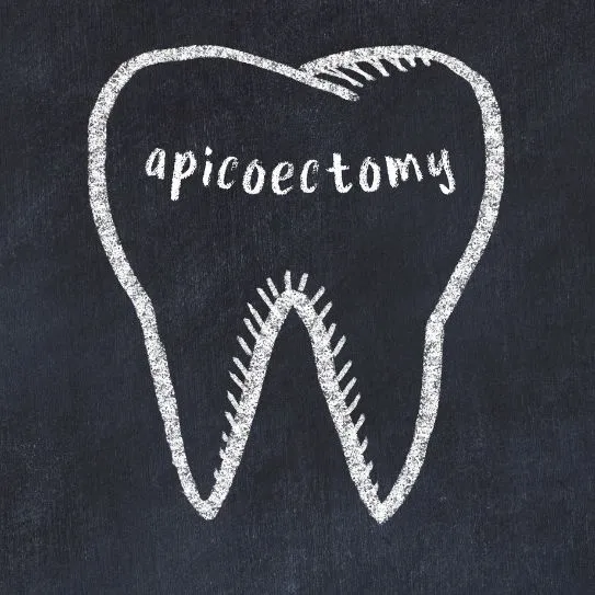 The Ultimate Guide to Apicoectomy: Saving Your Natural Tooth in Sterling