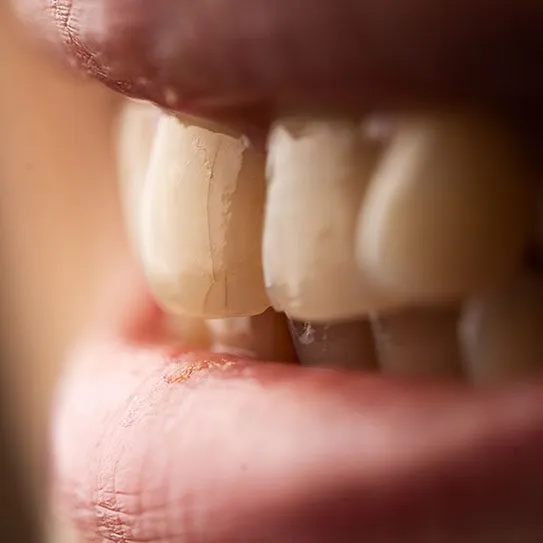 What Can Be Done for Cracked Teeth?