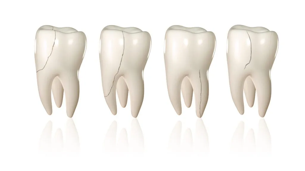 Understanding the 5 Different Types of Cracked Teeth: What You Need to Know
