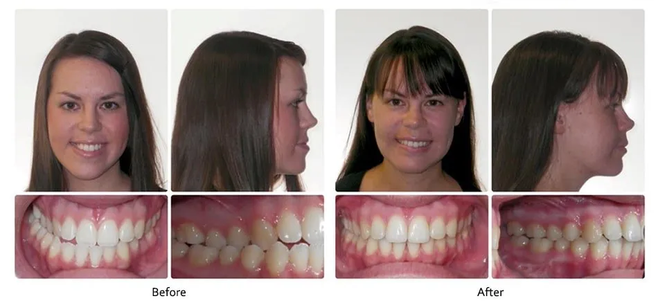 Before and after orthodontic treatment, case 8