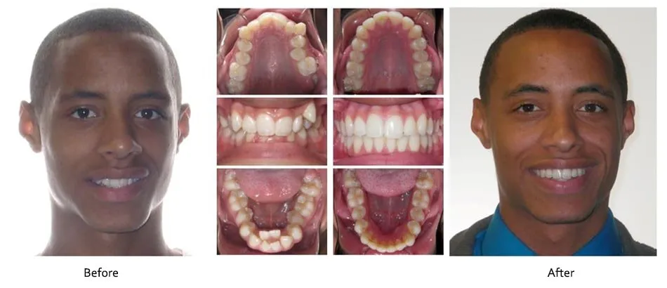 Before and after orthodontic treatment, case 7