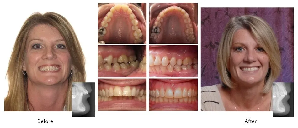 Before and after orthodontic treatment, case 6