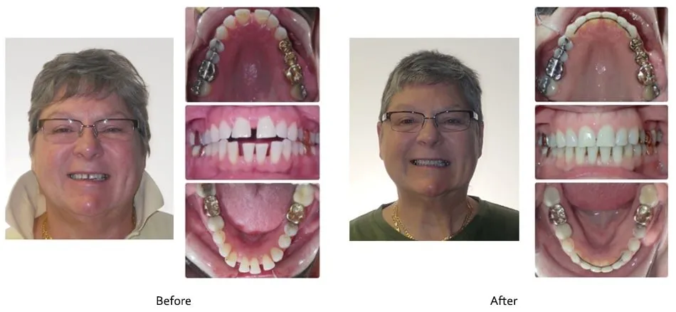 Before and after orthodontic treatment, case 9