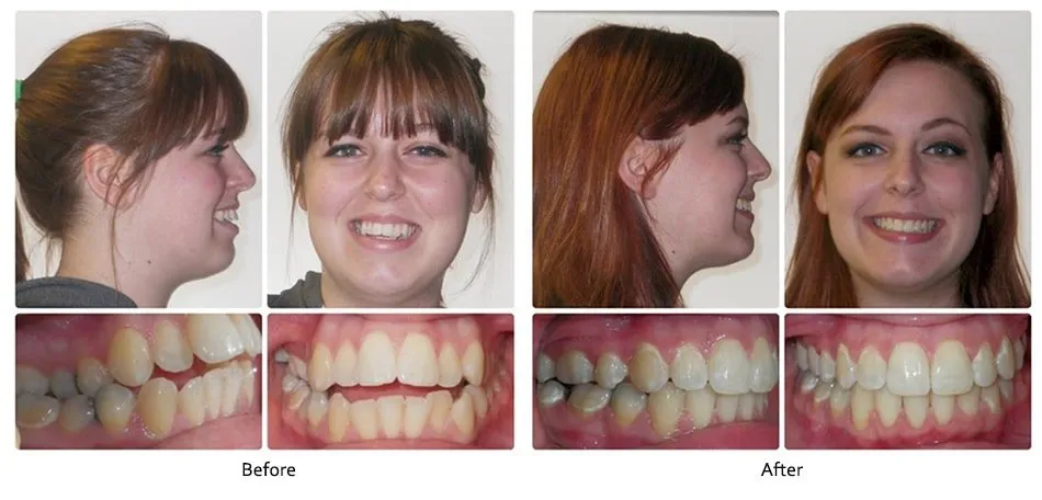 Before and after orthodontic treatment, case 3