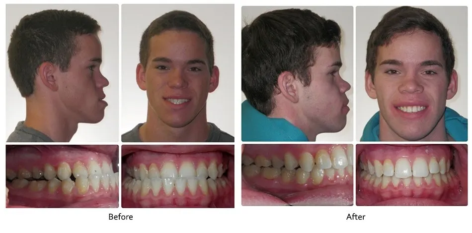 Before and after orthodontic treatment, case 10
