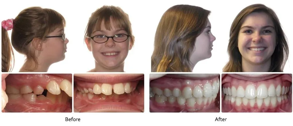 Before and after orthodontic treatment, case 5