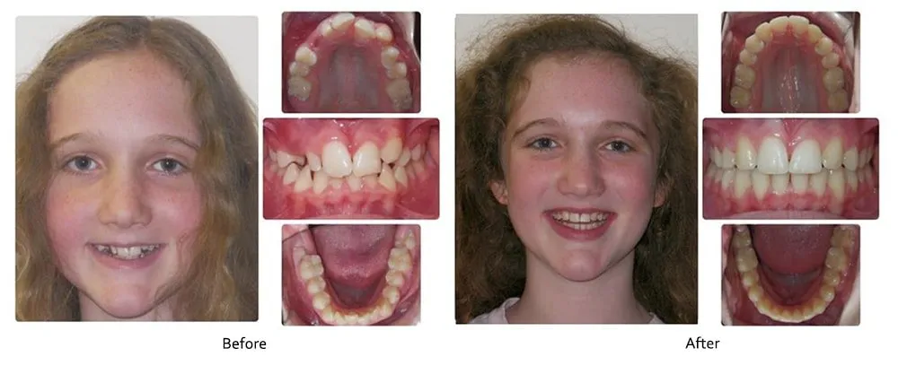 Before and after orthodontic treatment, case 2