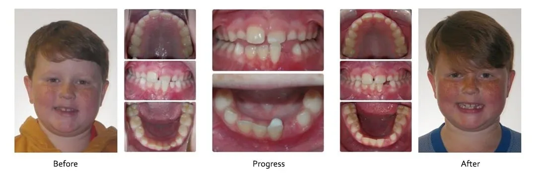 Before and after orthodontic treatment, case 1