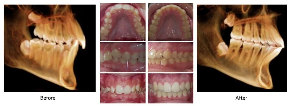 Before and after orthodontic treatment, case 4