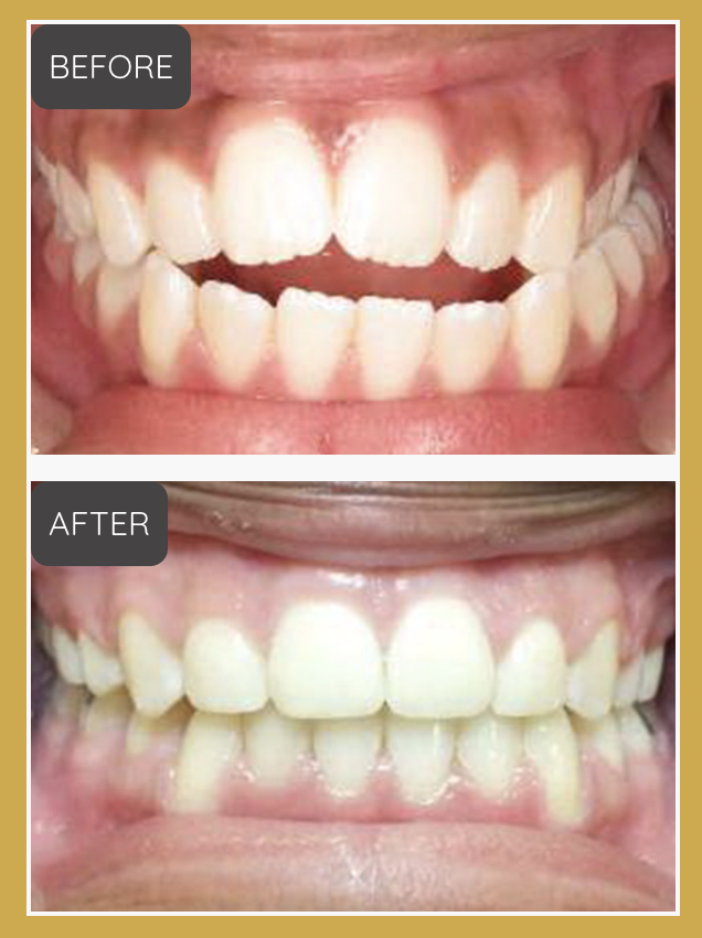 Dental before-and-after comparison showing teeth with an open bite (BEFORE) and corrected alignment (AFTER), set against a gold-bordered frame. Mid-quality clinical photography suitable for orthodontic treatment results.
