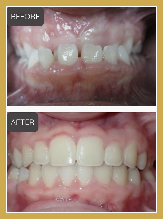 Dental before-and-after comparison showing crowded and misaligned teeth (BEFORE) and straightened teeth (AFTER), in a gold-bordered frame. Slightly blurry clinical photography but content is clear.