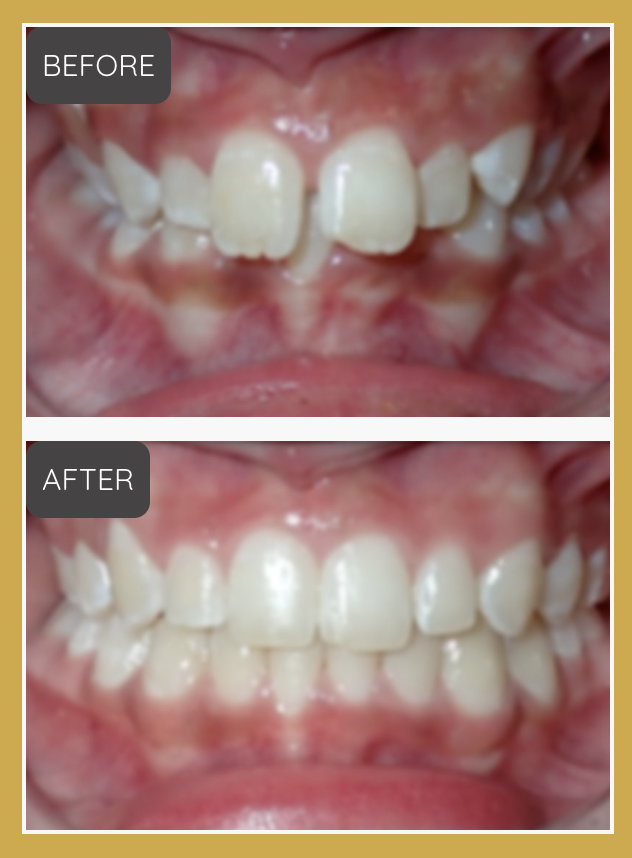 Dental before-and-after comparison showing crowded upper teeth (BEFORE) and improved alignment (AFTER), in a gold-bordered frame. Lower resolution and slightly blurry compared to the other treatment photos.