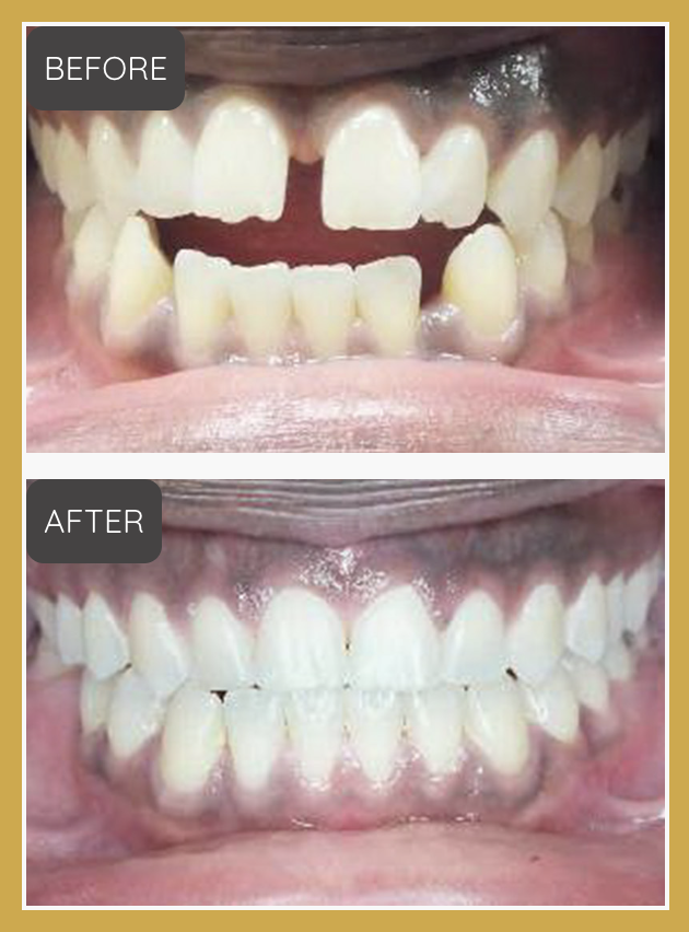 Dental before-and-after comparison showing a large gap between front teeth (BEFORE) and corrected, aligned teeth (AFTER), in a gold-bordered frame. Reasonably clear clinical photography demonstrating orthodontic gap closure.