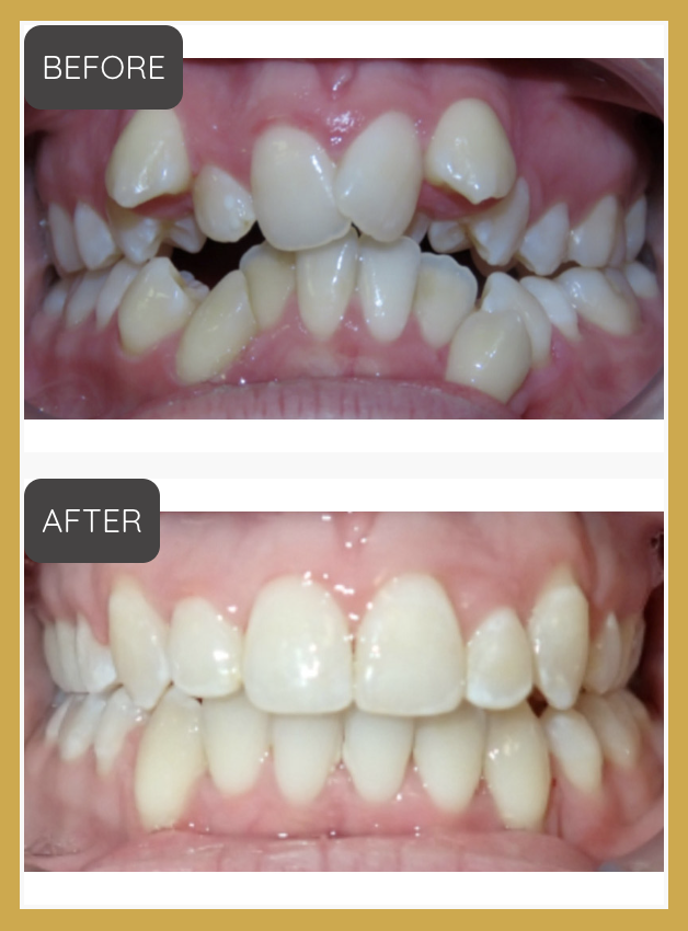A before-and-after orthodontic treatment comparison showing crowded, misaligned teeth labeled 'BEFORE' and a well-aligned smile labeled 'AFTER' on a gold-bordered background. The image clearly demonstrates orthodontic results.