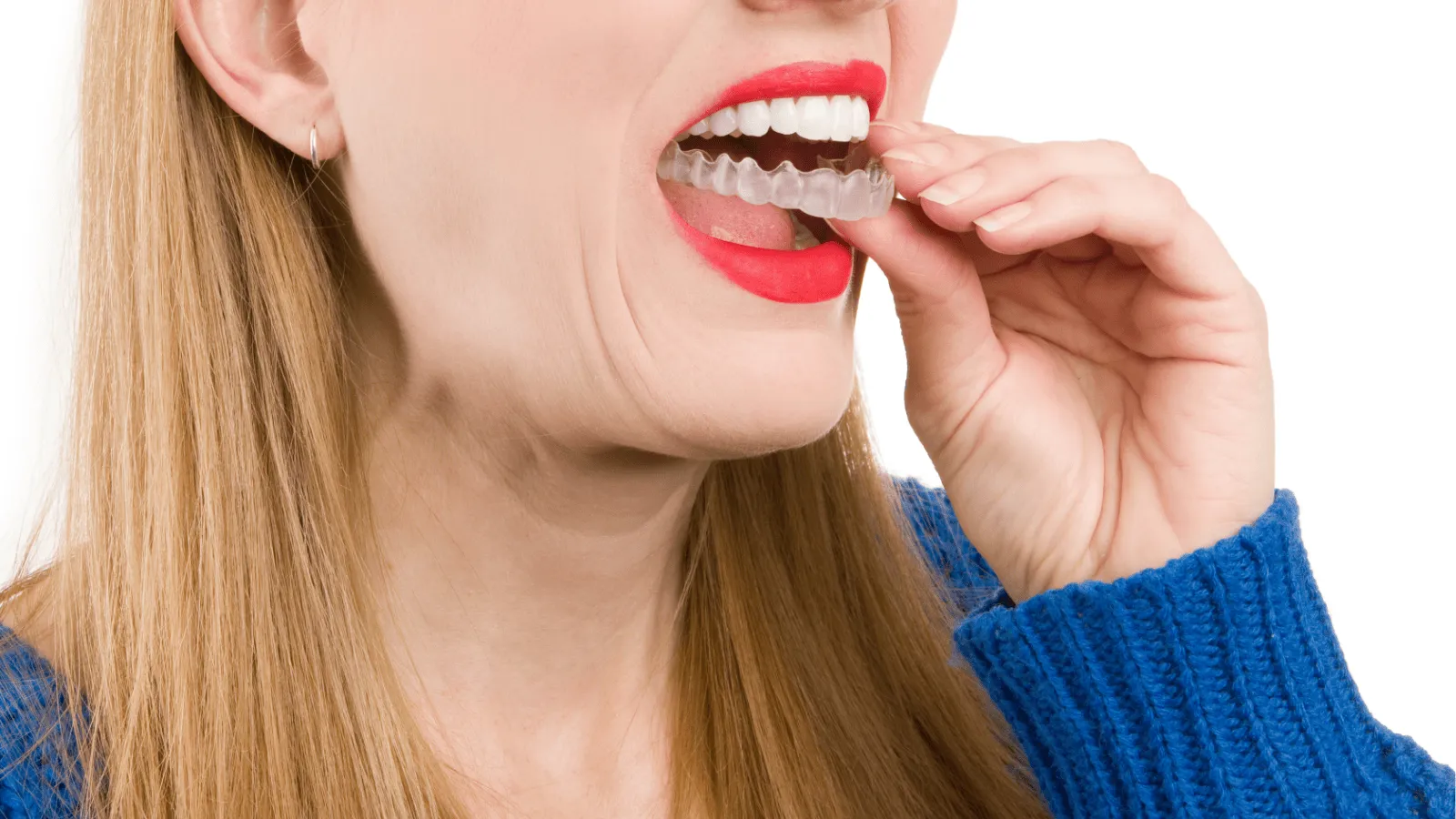 How Long Does Clear Aligner Treatment Take? What Affects Your Timeline