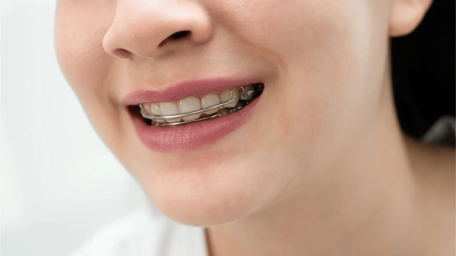 What Happens If You Skip Wearing Your Retainer?