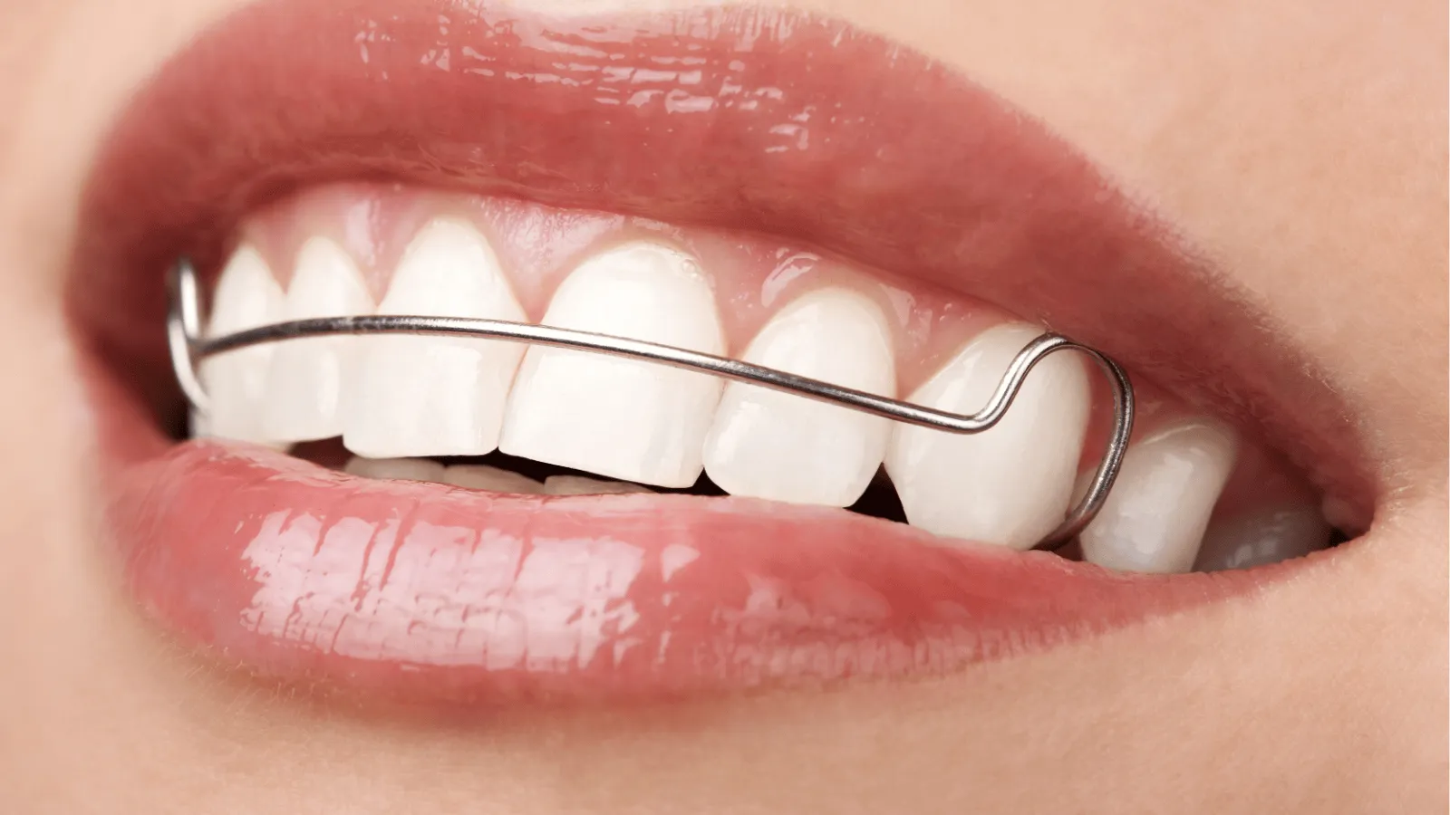 Types of Retainers: Which One Fits You Best?
