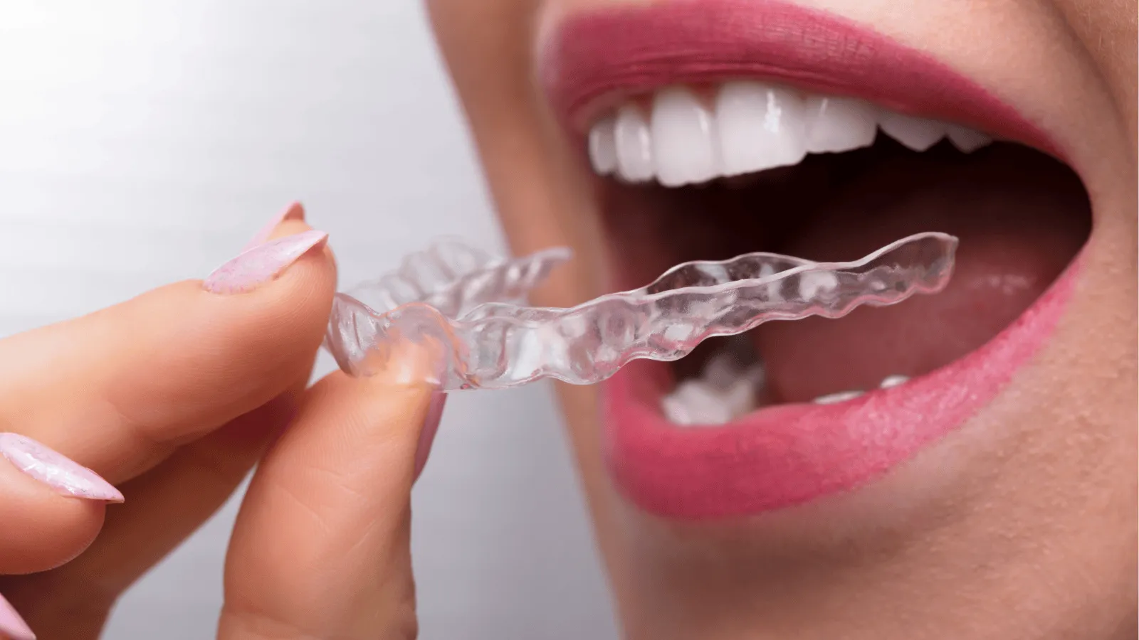 The Step-by-Step Process of Getting Clear Aligners