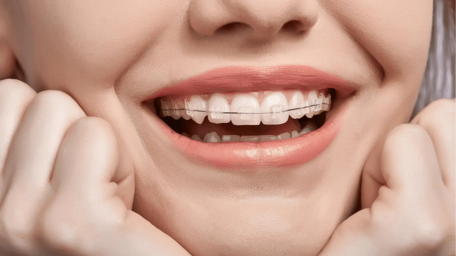 Why Retention Is Just as Important as Braces