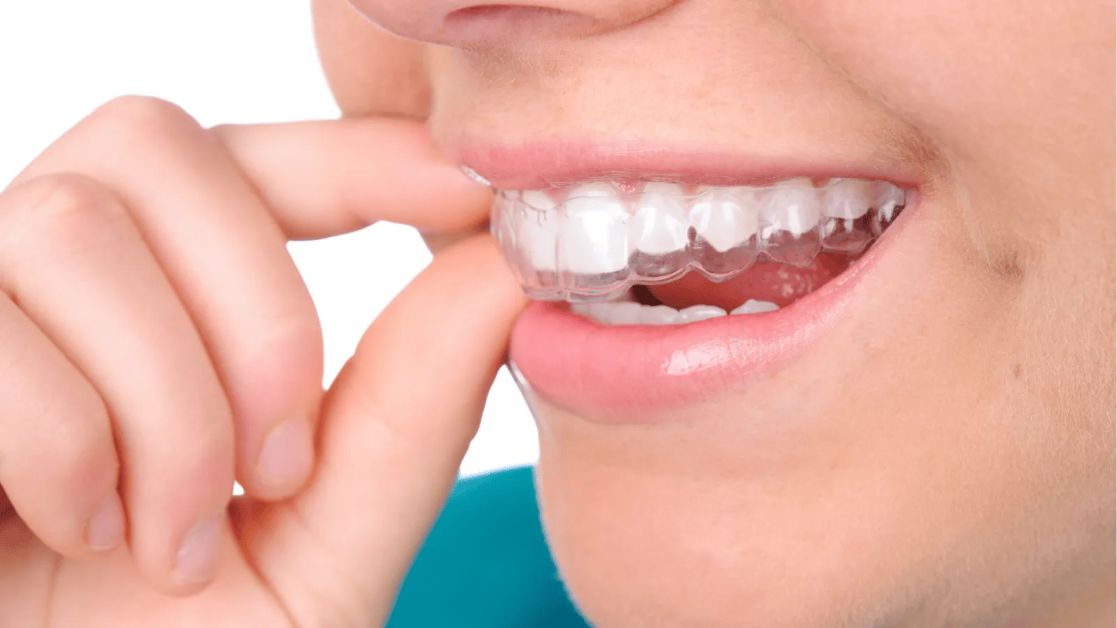 How Long Should You Wear Your Retainer? Expert Insights