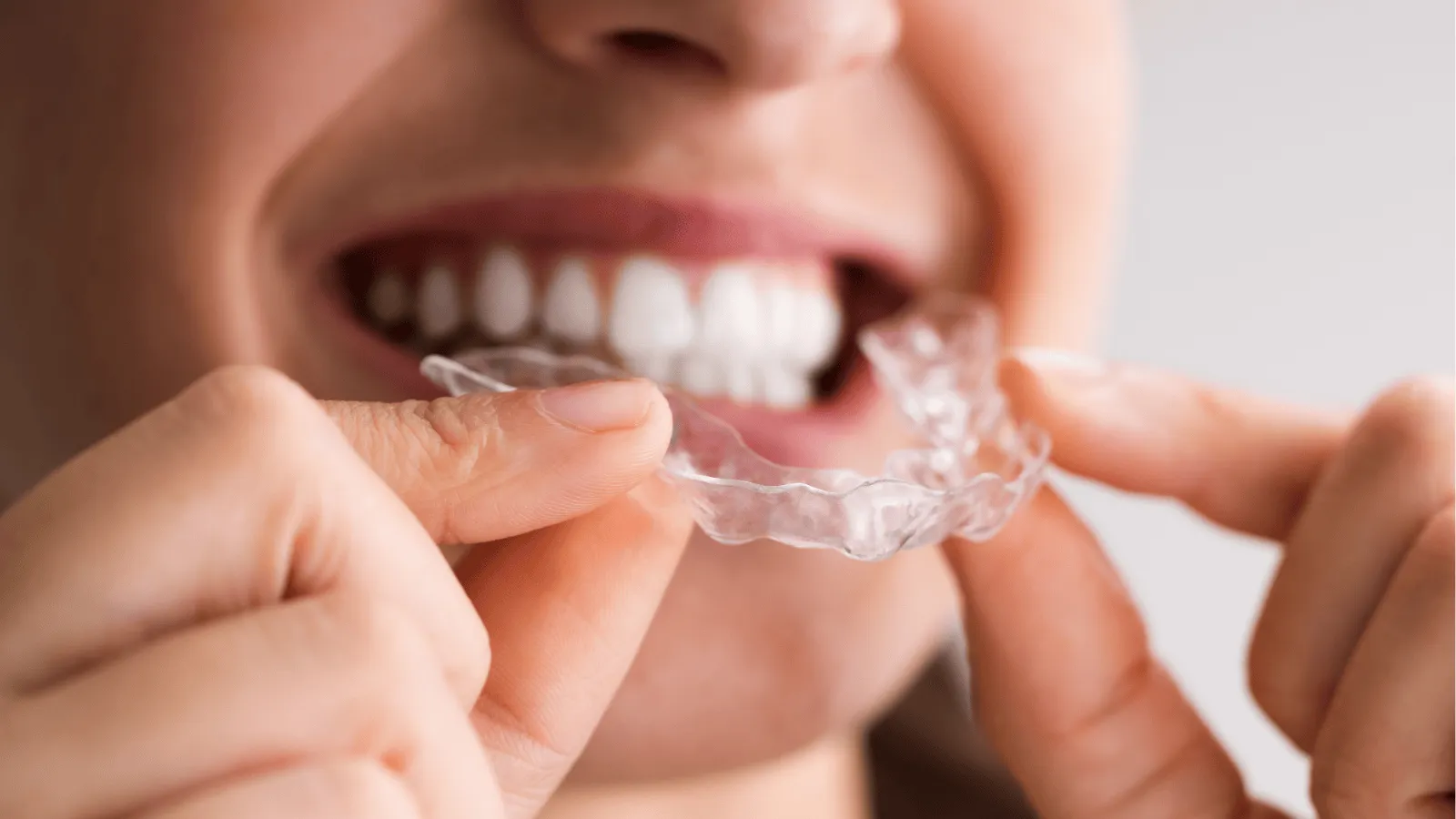 10 Things to Know Before Starting Clear Aligner Treatment