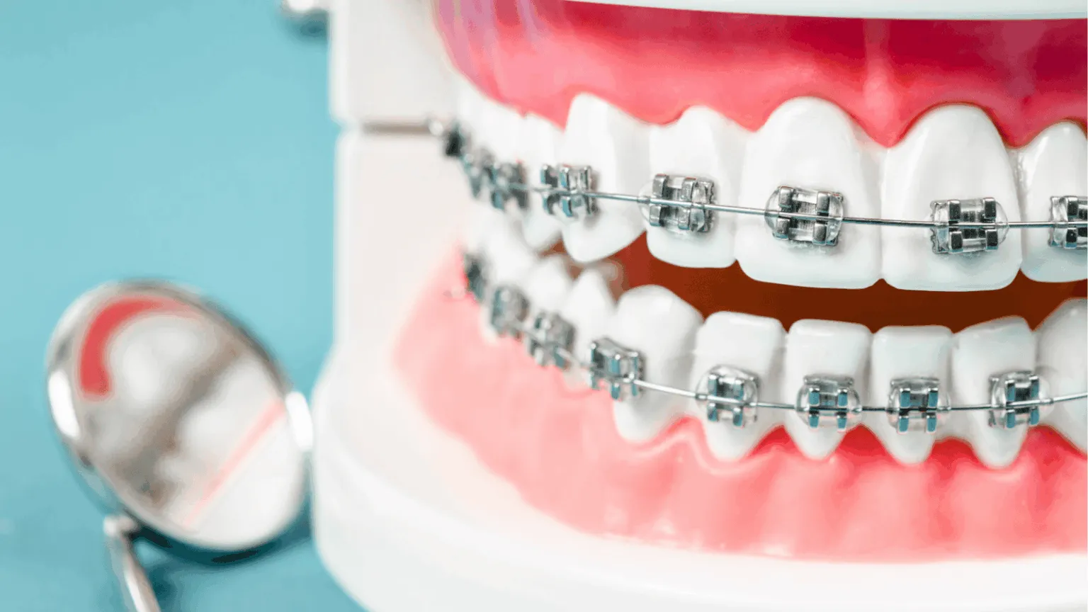 Metal Braces vs. Ceramic Braces: Which Option is Right for You?