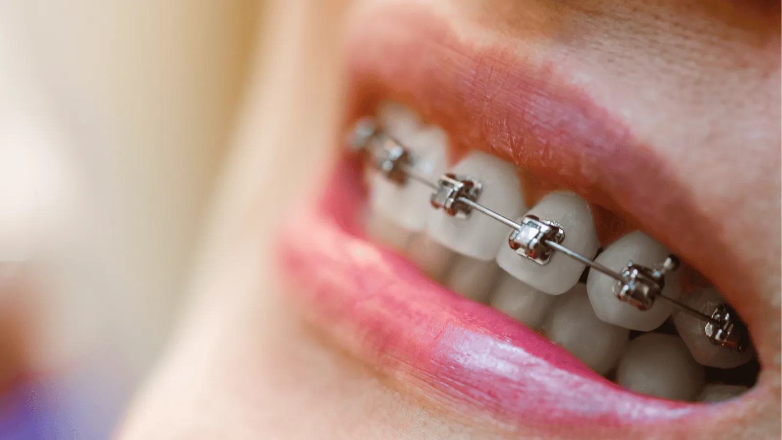 What Happens After Braces Come Off? Your Post-Treatment Guide
