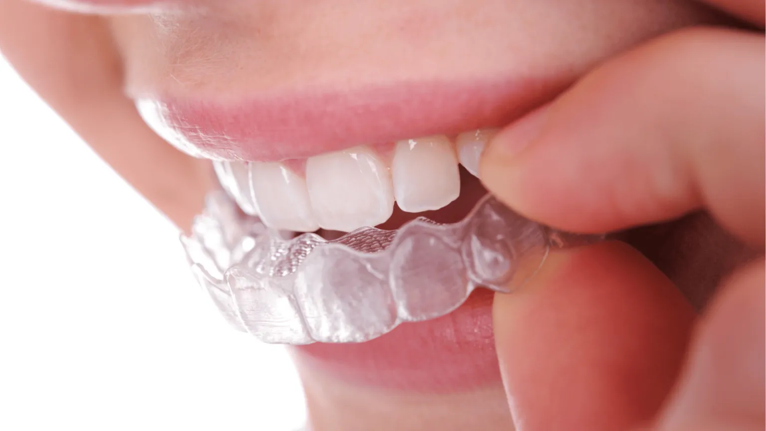 The Role of Retainers: Why They’re Just as Important as Braces