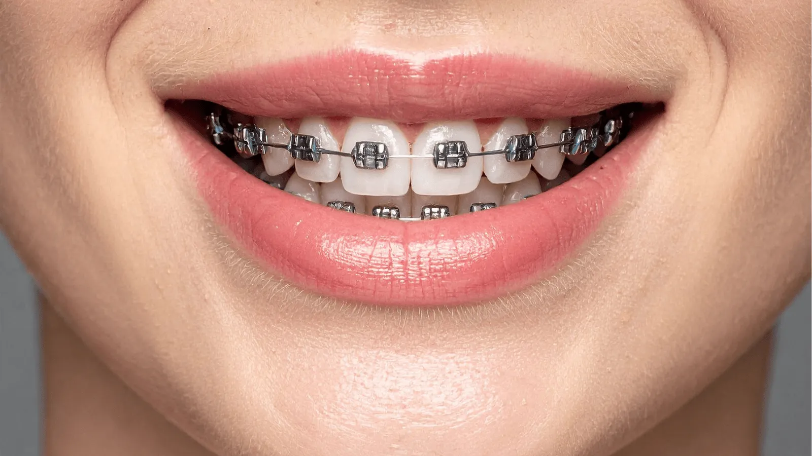 Can I Wear Braces If I Have Periodontal Disease?