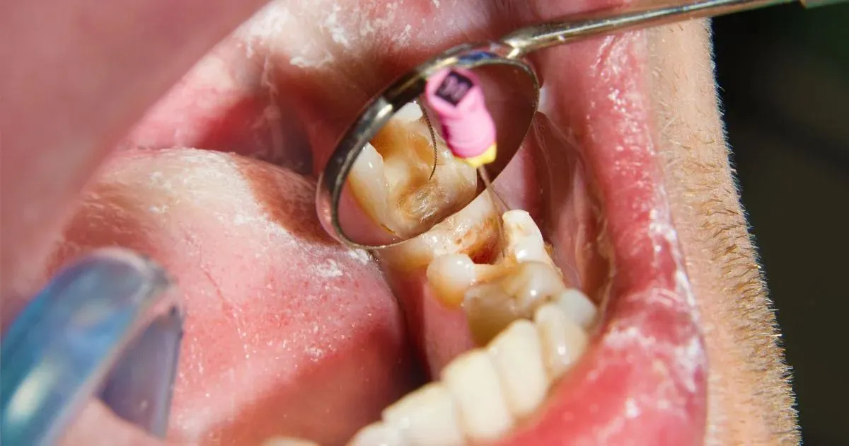 Why You Might Need a Root Canal and Not Even Know It