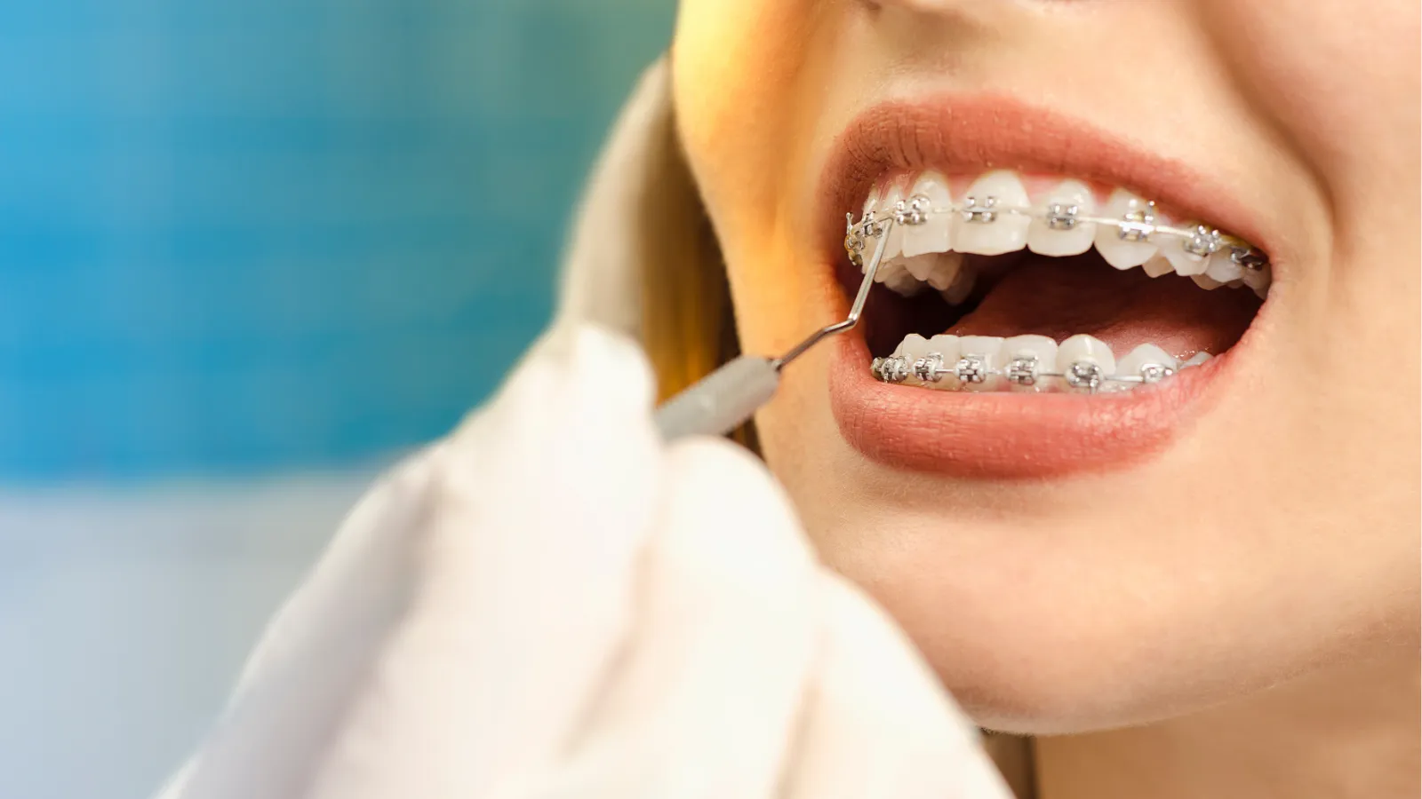 The Benefits of WildSmiles Braces for a Personalized Orthodontic Journey