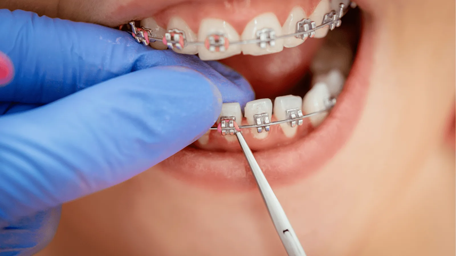 What Happens After Braces Come Off? Your Post-Treatment Guide