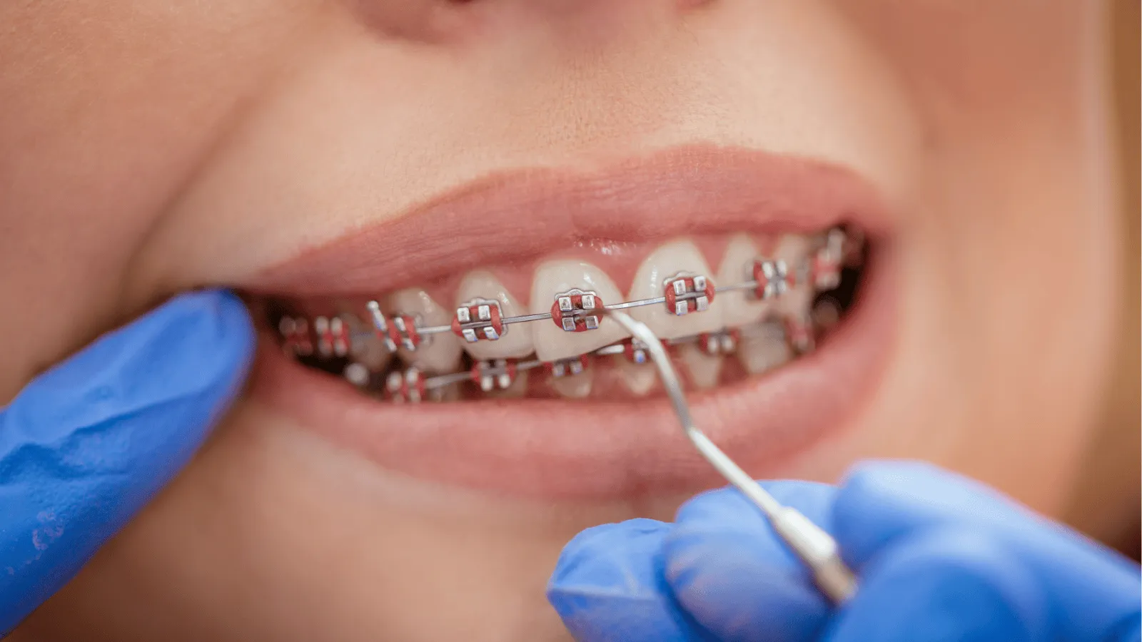 10 Signs You Might Need Braces (Even as an Adult)