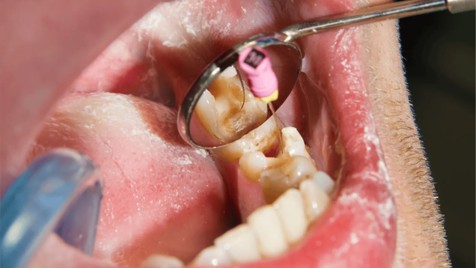 Healing After Root Canal Microsurgery: Recovery Tips and Timeline