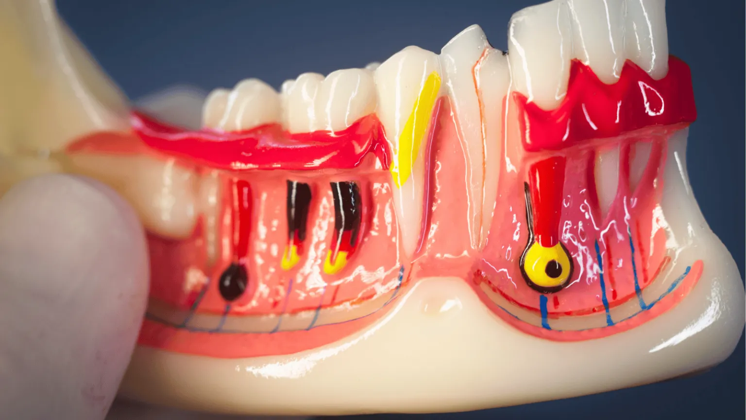 What Is an Apicoectomy and When Do You Need One?