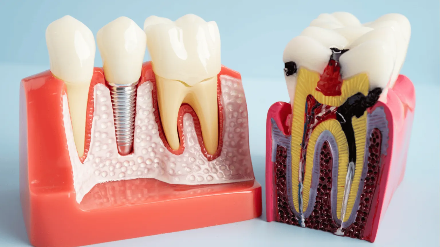 Pulpotomy vs. Root Canal: What’s the Difference and When Is Each Used?