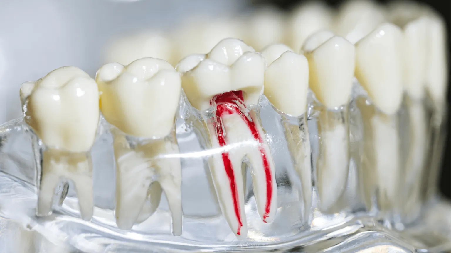 Why Would A Root Canal Need To Be Redone? Understanding Retreatment