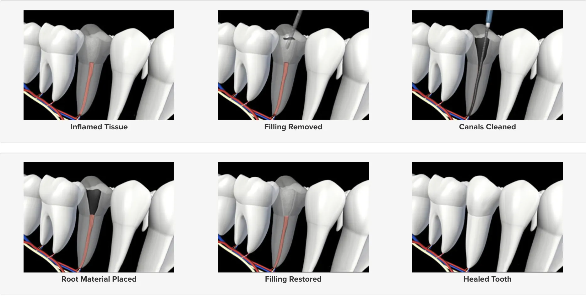 Endodontic Retreatment